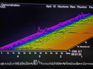 QEEG Brain Mapping